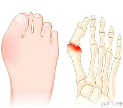 Hallux Valgus: Potpuni znanstveni vodič