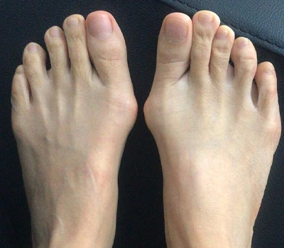 Mjerenje Hallux Valgus: Zašto 3D skeneri nadmašuju kliničare i bolnice