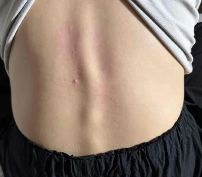Sveobuhvatna analiza skolioze: razumijevanje stanja i tehnoloških inovacija u procjeni i liječenju